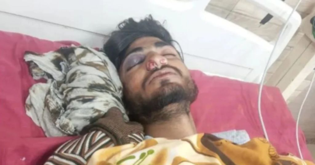 बंदरों के हमले के बाद ICU में भर्ती छात्र कृष्णा 